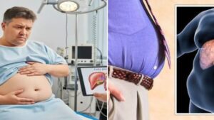 5 Reasons You May Develop Fatty Liver – And How to Prevent It