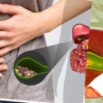 If You Have Gallstones, Never Eat These Foods – Doctor Shares Natural Remedies to Help Break Them Down